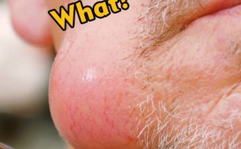 25 Causes of Raised Skin Bumps (with Pictures & Video)