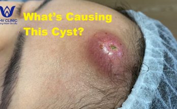 What’s Causing This Cyst?