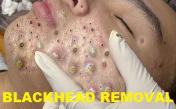 Blackheads: What They Look Like, Treatment & Prevention