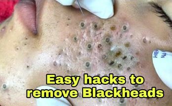 Simple Easy Hacks to Remove Blackheads on Nose