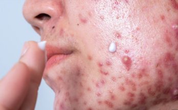 How to Treat Hormonal Acne and Use Natural Remedies