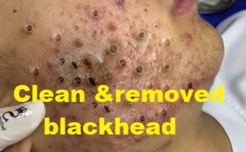 Clean and removed blackhead from your check