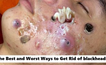 The Best and Worst Ways to Get Rid of Blackheads