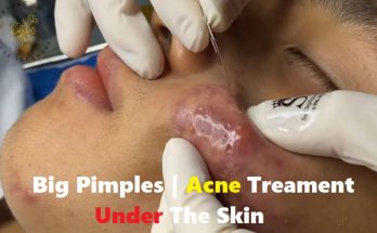 Big Pimples | Acne Treament Under The Skin