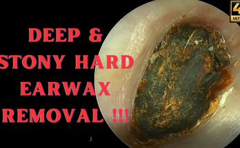 Massive Amount Of Earwax Extracted From This Ear!!! 6 things you need to know about earwax removal